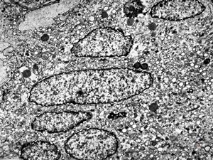 F, 45y. | necrobiosis lipoidica